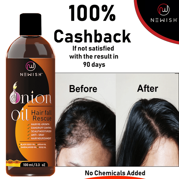 How To Control Dandruff And Hair Fall Naturally Lemon