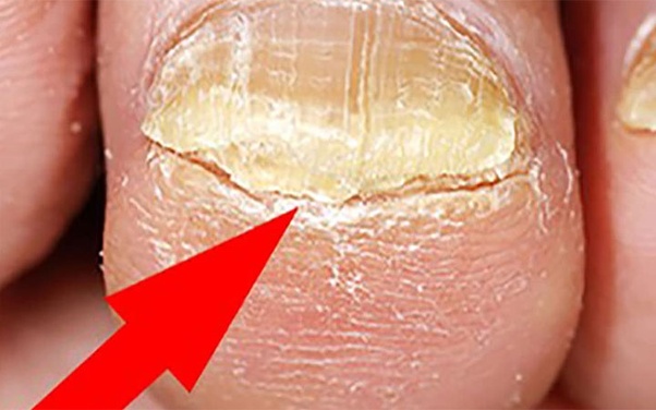 What happens if a person with a bad looking toenail fungus, goes to a