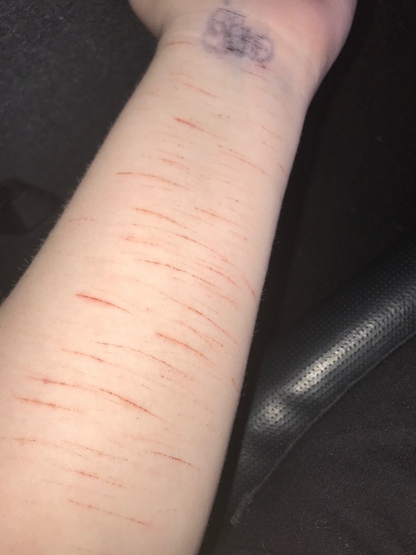 What is it like to live with self harm scars? Quora