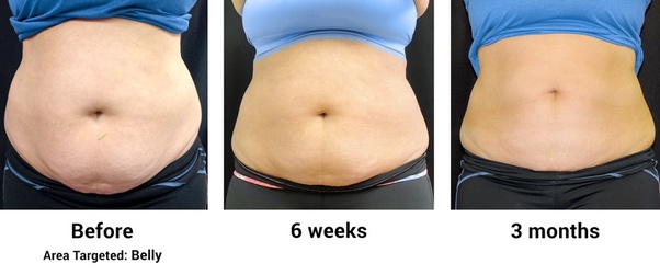Freeze Your Fat Cells At Home Review Home Co
