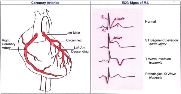 My EKG showed a previous heart attack. I had two incidents, would this