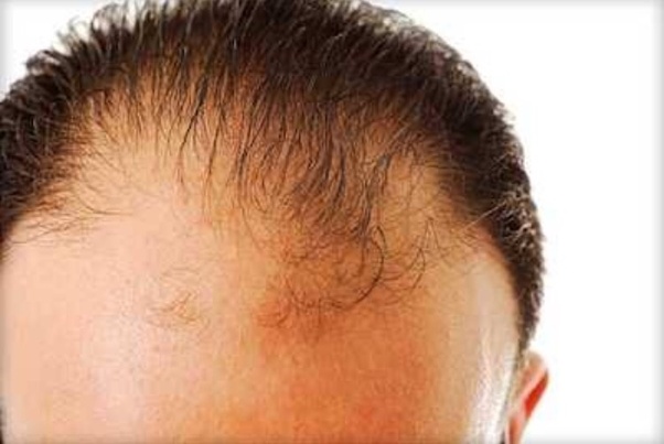 Which shampoo is the best to stop hair loss for men? Quora