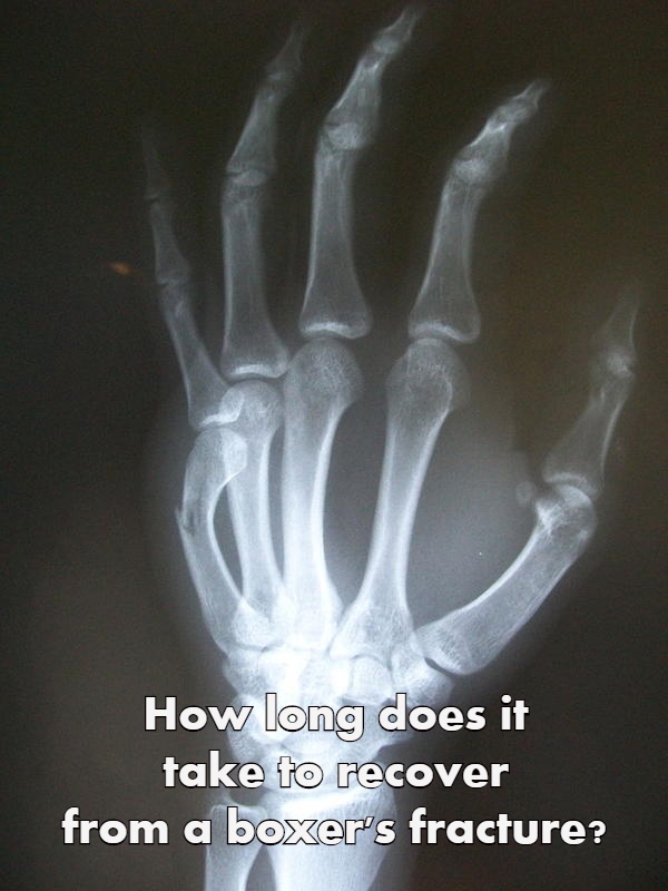 How long does it take to recover from a boxer's fracture