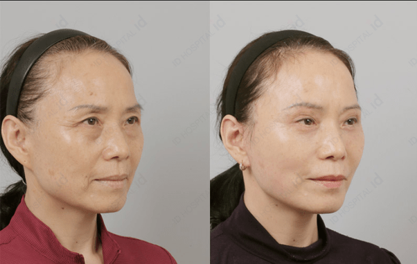What is the procedure of a facelift surgery? How much time does it take