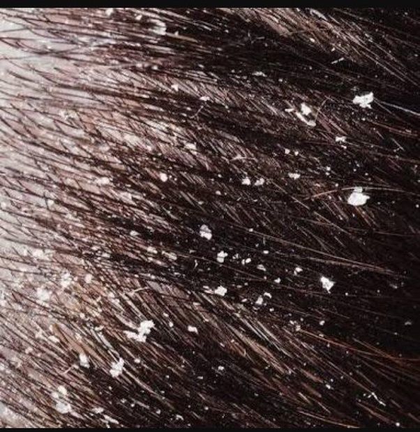 How to know if you have lice or dandruff Quora