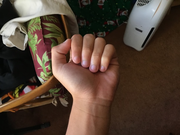 Have you ever gone through a nailbiting phase? Quora