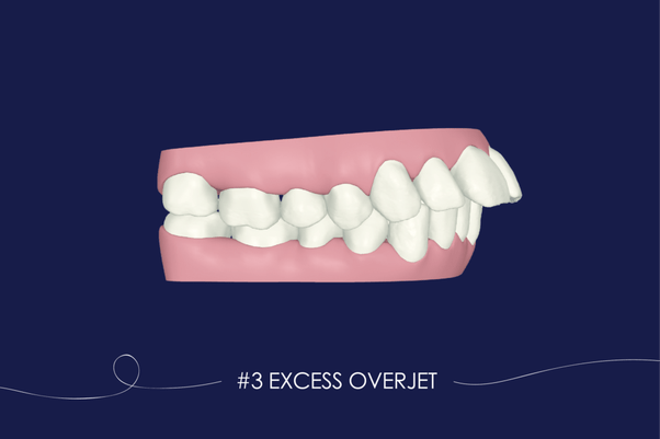 How much would it cost to fix crooked teeth? Quora