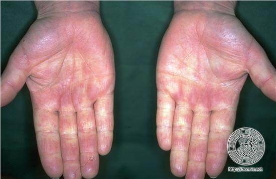 Why do my hands and feet occasionally get blatant purple and orange