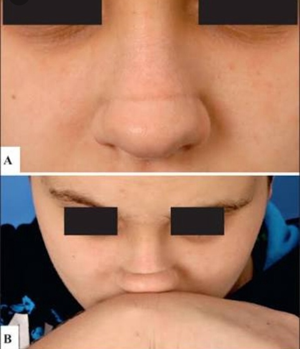 How To Get Rid Of Line Across My Nose How?