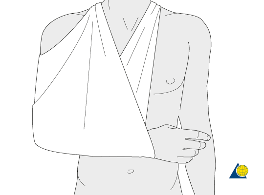 I broke my humerus 8 weeks ago but still am unable to