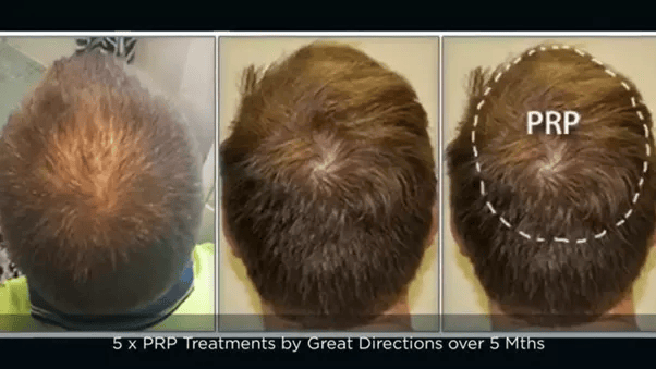 What is the success rates of PRP hair treatment and how many sessions