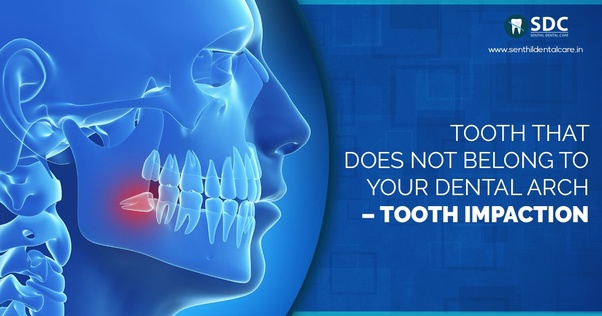 What is the cost to extract a wisdom teeth in Chennai? Quora