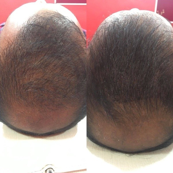 Has anyone had scalp micropigmentation to camouflage a