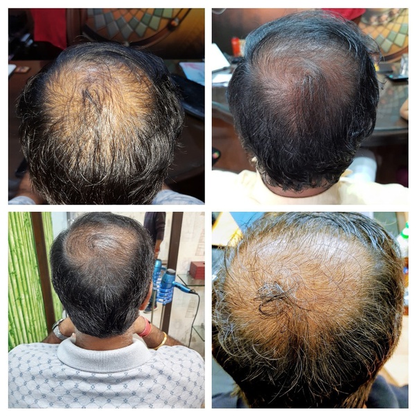 Is it possible to get hair regrowth at the age of 47? Quora
