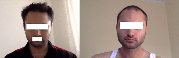 Does chewing gum make your jawline slimmer? Quora