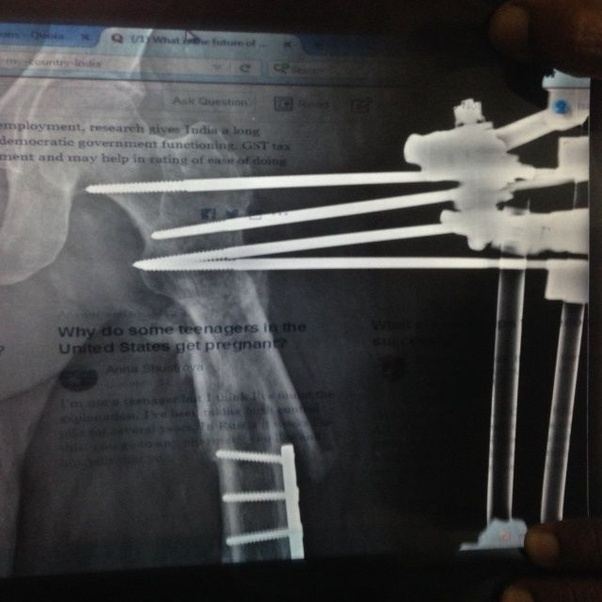 Why do orthopaedic surgeons do this? Quora