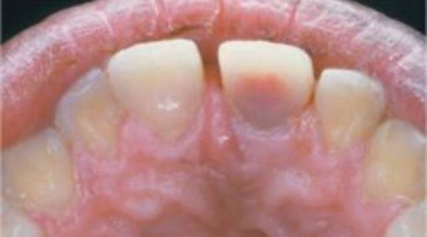 What does it mean when a tooth turns red? Quora