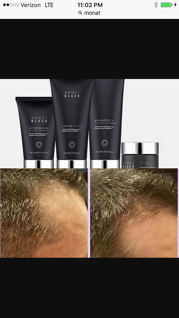 Should I shave my hair to go bald? Would it grow back fast