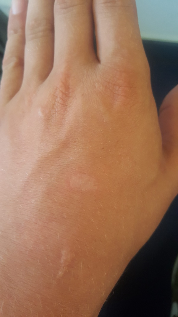 What does it feel like to be burned by acid? Quora