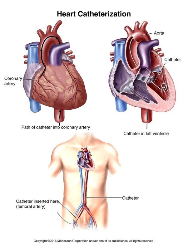 What is a heart catheterization? Quora