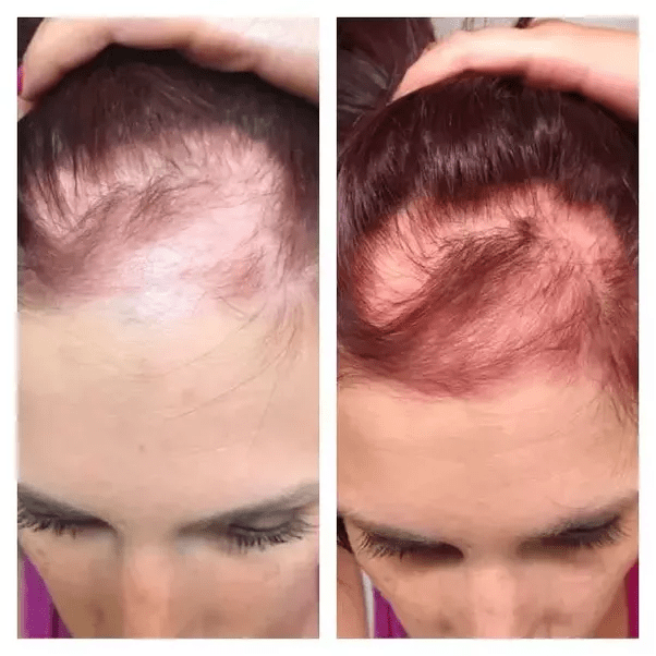 What are the best treatments to cure alopecia areata? Quora