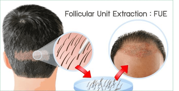 Has anyone had a successful hair transplant in India? If yes then how
