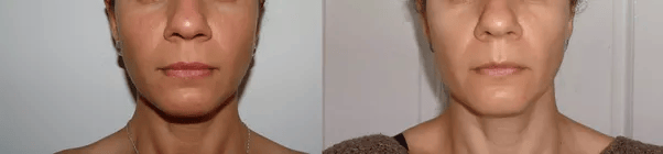 How will removing the wisdom teeth affect ones jaw line/structure and