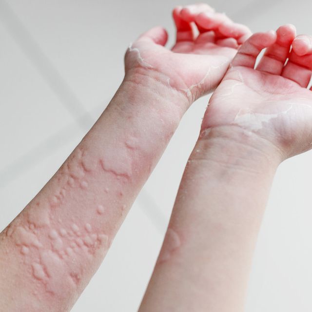 Apa yang terjadi pada kulit setelah digigit semut api? - Quora