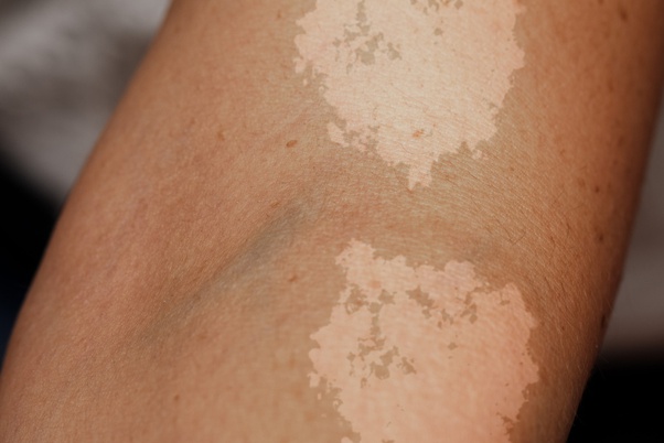 Is each and every white spot vitiligo? Quora