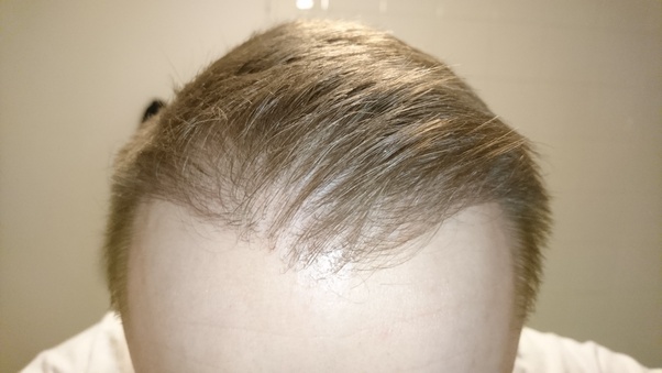 How Long Does a Hair Transplant Take to Heal