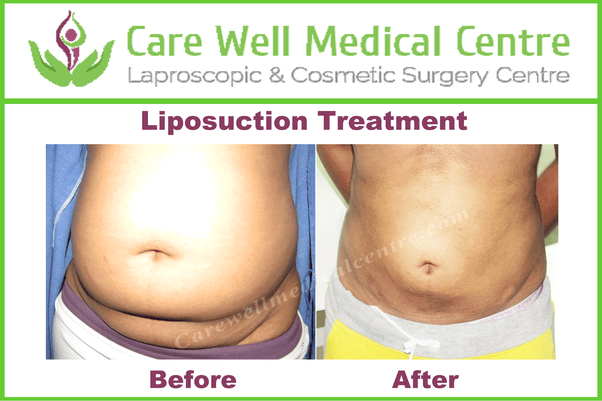 How much will liposuction cost in India? Quora