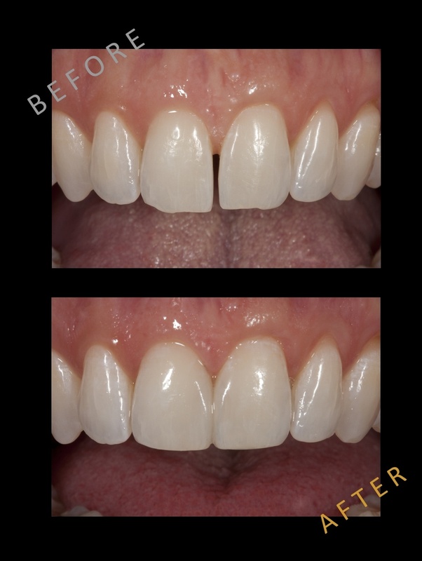 What is the best way to close gaps between teeth without
