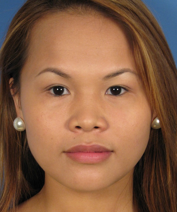 Why do most white people have pointed noses? Quora