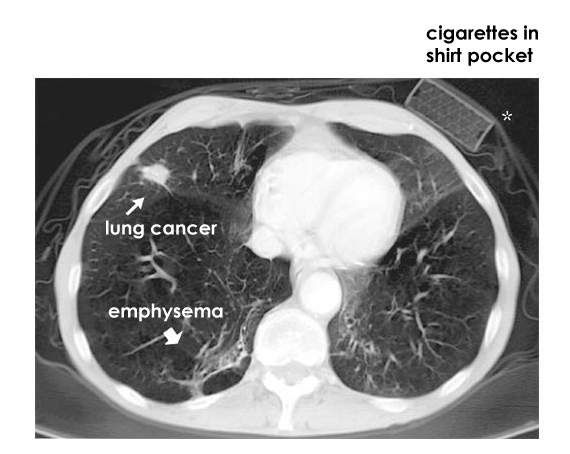 Can You Detect Lung Cancer With Ct Scan COPD on emaze It gives