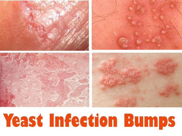 Do you break out in bumps when you have a yeast infection? Quora