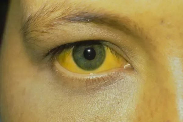 How To Treat A Yellow Discoloration On My Skin - Quora