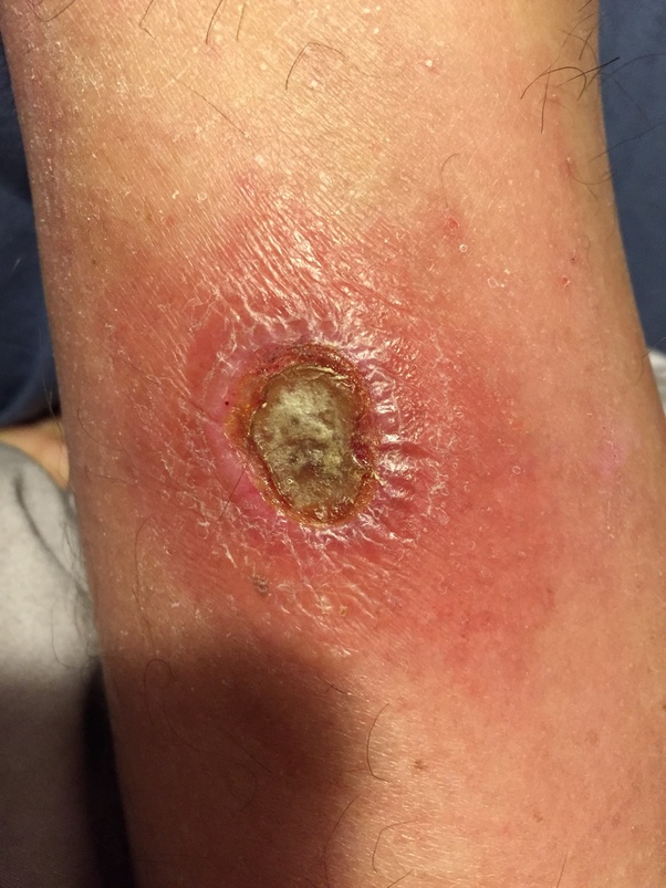 What does a spider bite look like? Quora