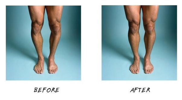 Can anyone tell any exercise to improve bow legs problem? Quora