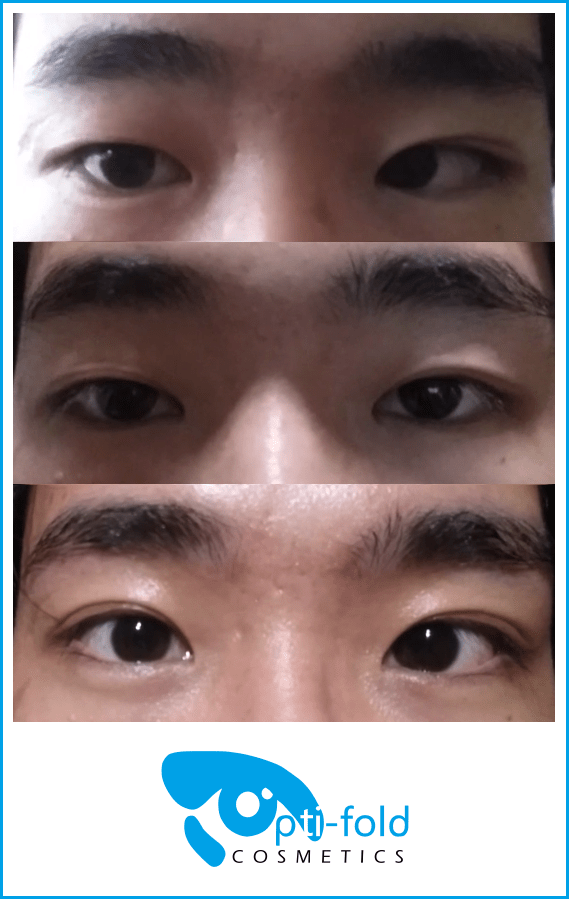 Why do some people have a hidden double eyelid? Quora
