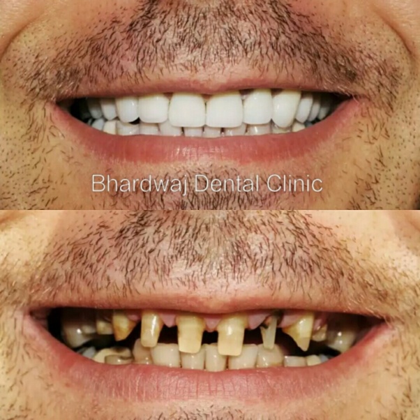 What is the cost of a 3M zirconia crown? Quora