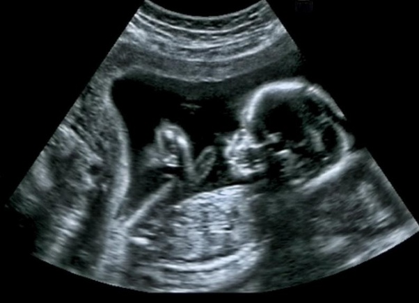 Can an internal ultrasound detect an early pregnancy? Quora