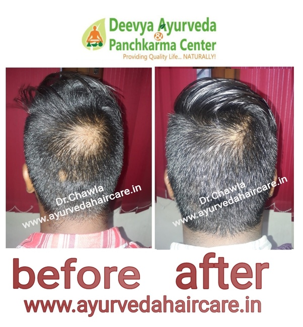 How to cure alopecia by Ayurvedic medicine Quora