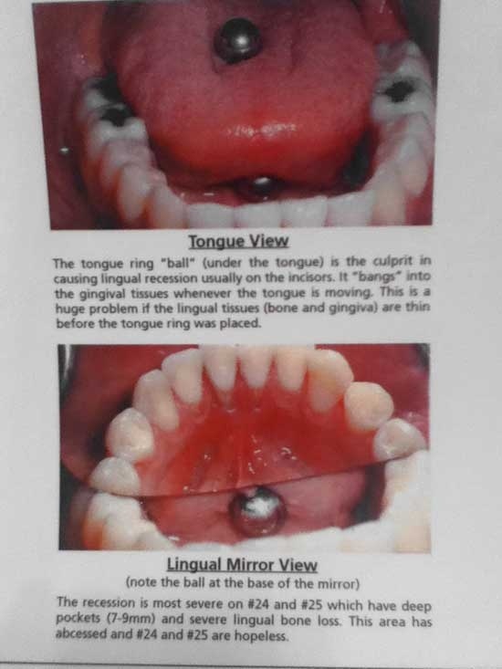 Is it dangerous to get your tongue pierced? Quora