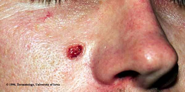 Can a doctor biopsy a mole which you used a home remedy to get rid of