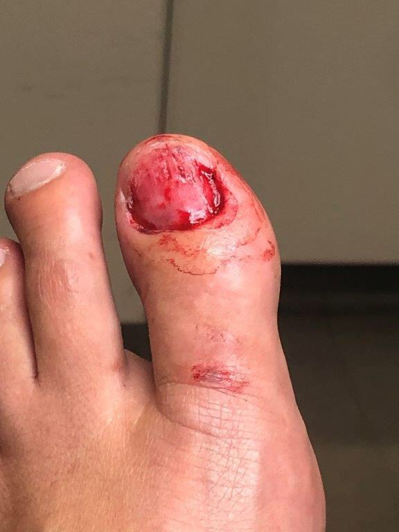 How does it feel to have your nail ripped off? Quora