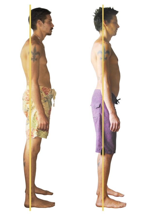 If anyone has had success in correcting kyphotic posture