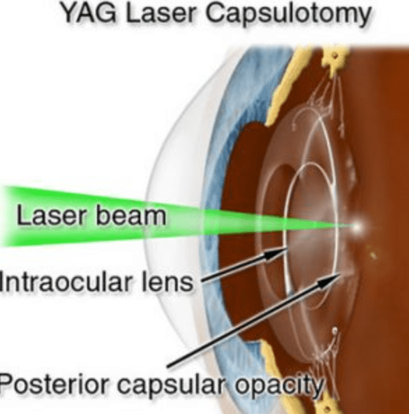 What are the “cells” that appear on an implanted lens after cataract