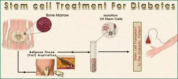 Is type 1 diabetes treatable with stem cell therapy in India? Quora