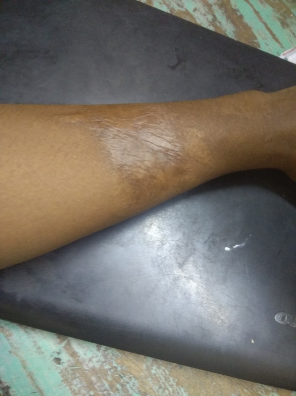 How to treat the scar and marks left from a hot water burn many years