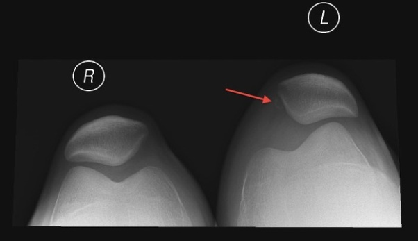 Why can some people move their knee caps? Could this cause issues for